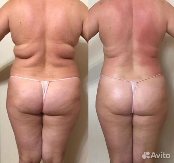 Коррекция фигуры, Похудение. Набор моделей