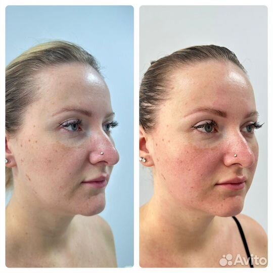 Скульптурный массаж лица