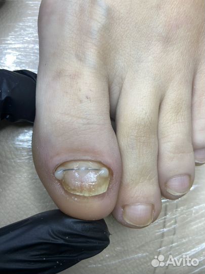 Подолог /Титановая нить