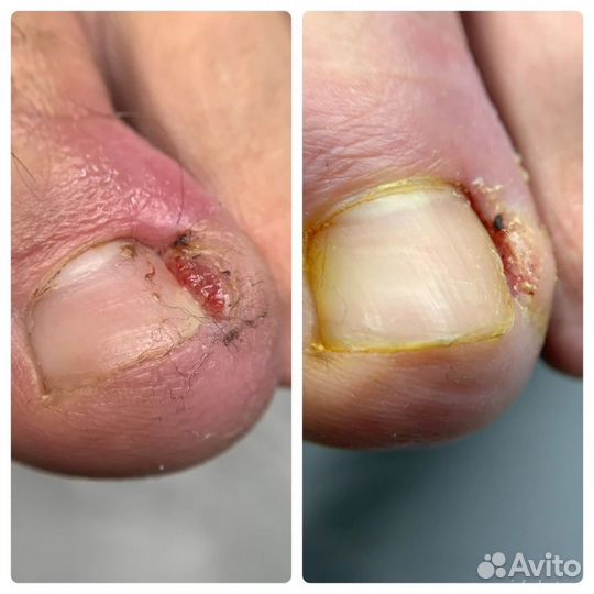 Подолог амур / шипица/грибок/вросший ноготь