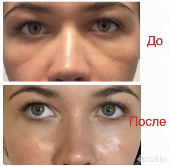 Биоревитализация