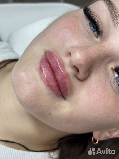 Увеличение губ