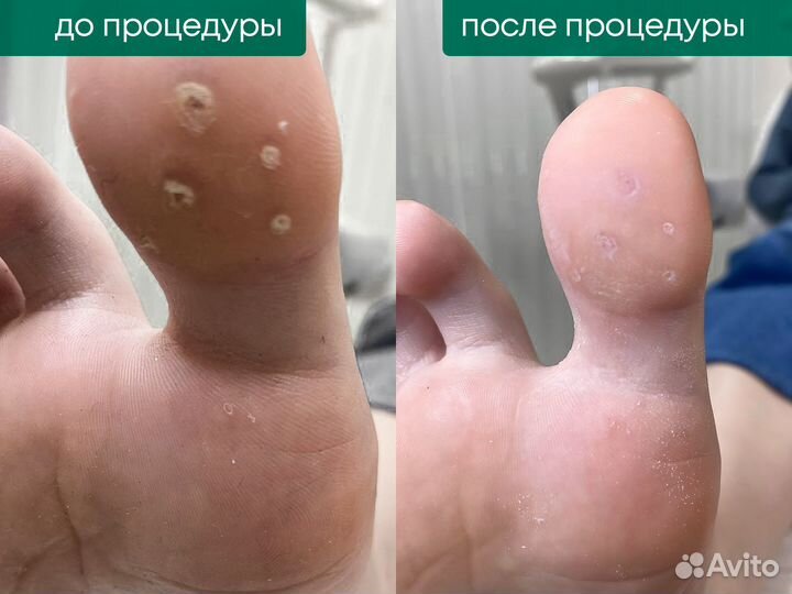 Подолог, лечение грибка, вросшие ногти, мозоли