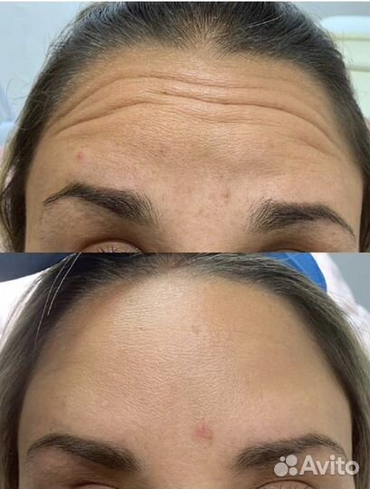 Убрать морщины ботокс