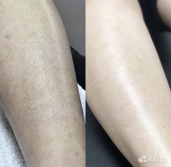 Депиляция Шугаринг Ваксинг