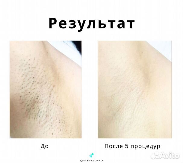 Аппарат для эпиляции Lumines Макс’Ван 1200