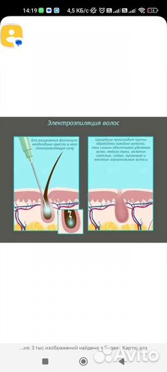 Электроэпиляция