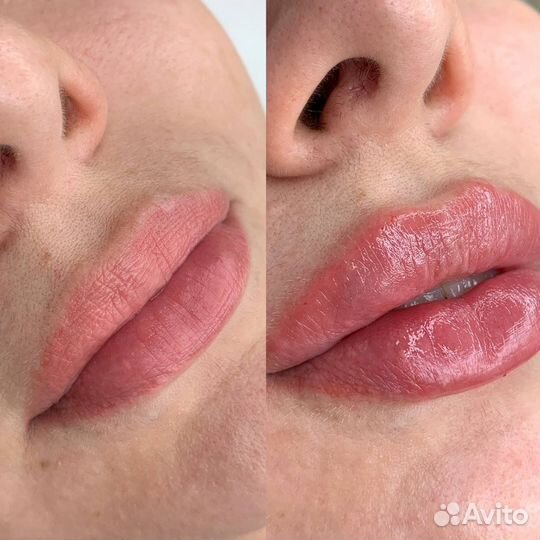 Увеличение губ натурально и красиво. Косметолог