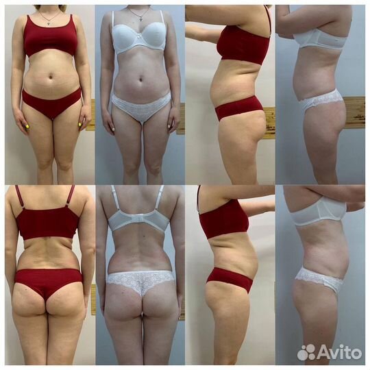 Аппаратное похудение, гарантированный результат