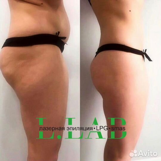 Lpg массаж Коррекция фигуры Похудение