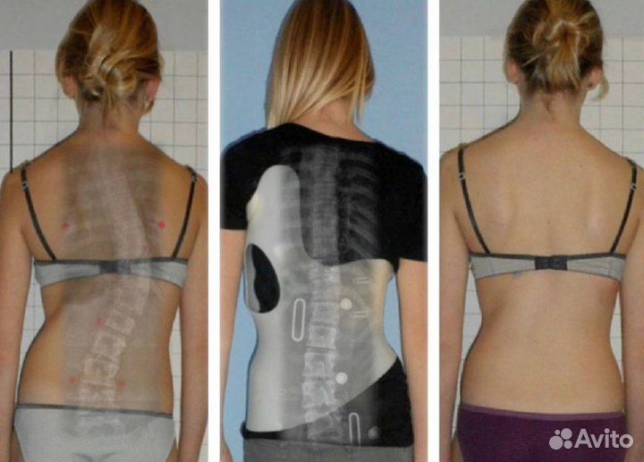 Лечение сколиоза корсетом Шено