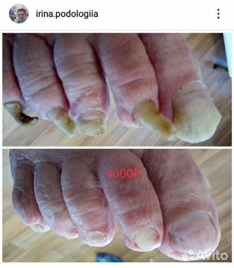 Педикюр гигиенический (медицинский). Выезд на дом