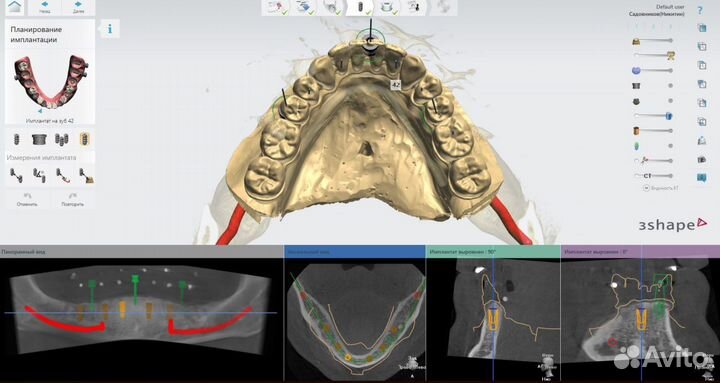 Создание навигационных хирургических шаблонов