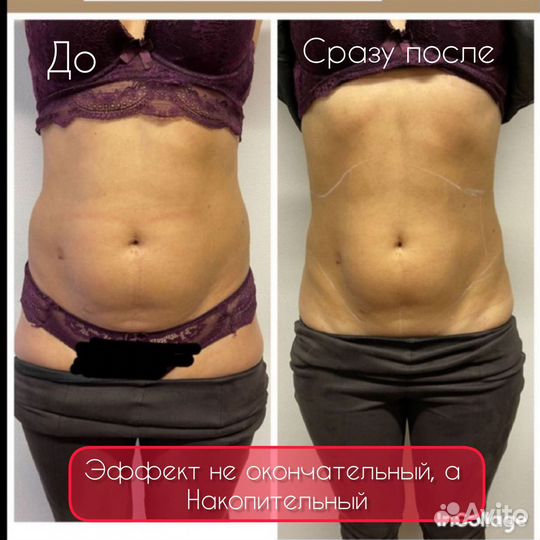 Коррекция фигуры не требующая курса(липосоникс)