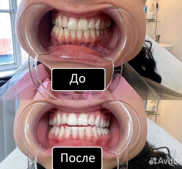 Отбеливание зубов