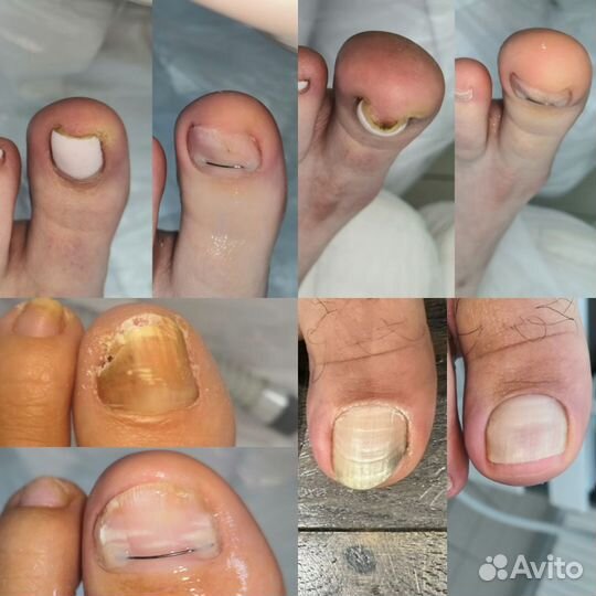 Титановая нить