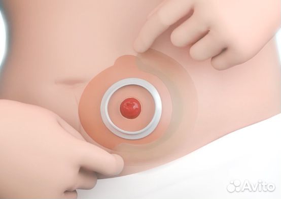 Эластичная пластина-полукольцо для стомы