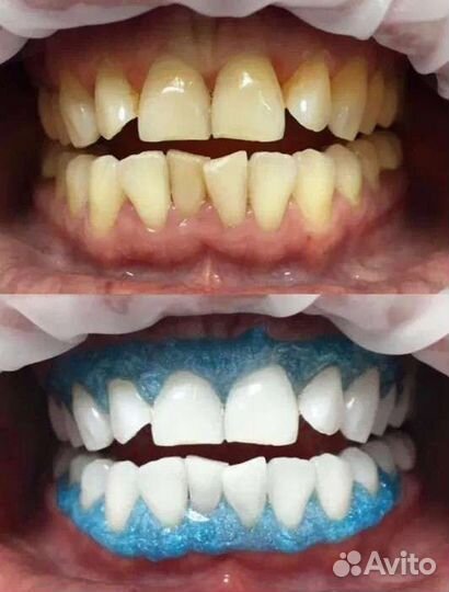 Купон на отбеливание зубов