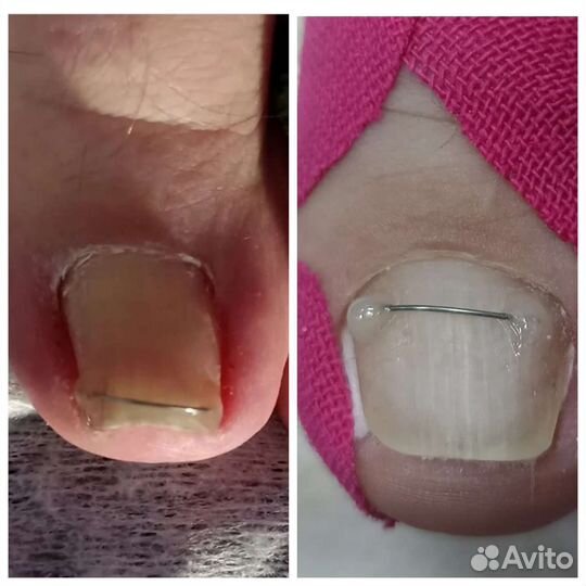 Подолог. Педикюр, вросший ноготь, сложные стопы