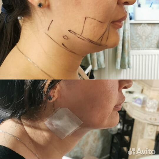 Липосакция подбородка. Увеличение губ. Ботокс