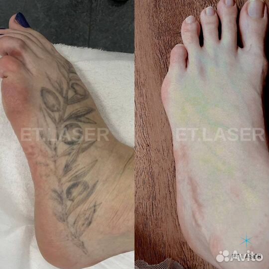 Удаление тату