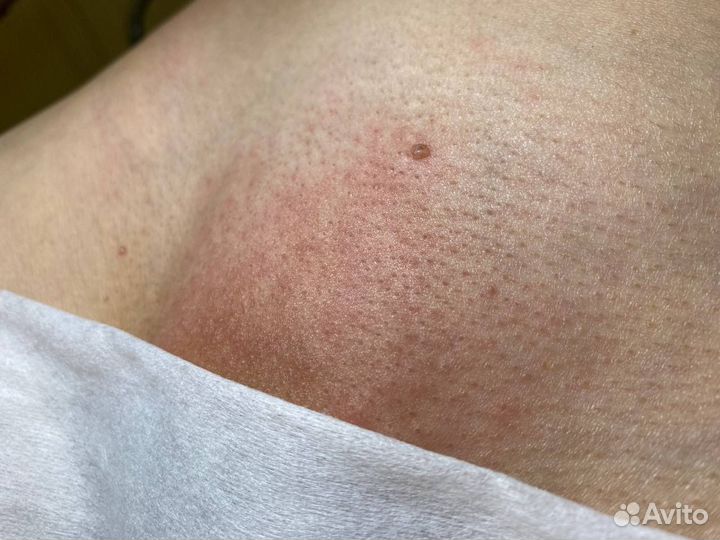 Электроэпиляция
