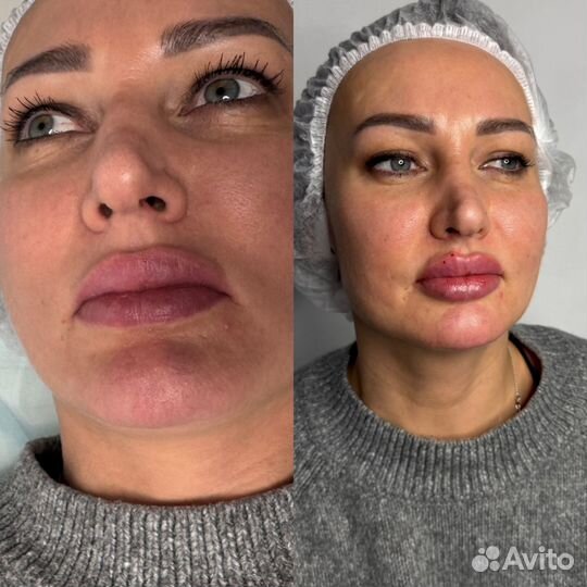 Увеличение губ