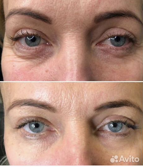 Подтяжка кожи верхнего и нижнего века