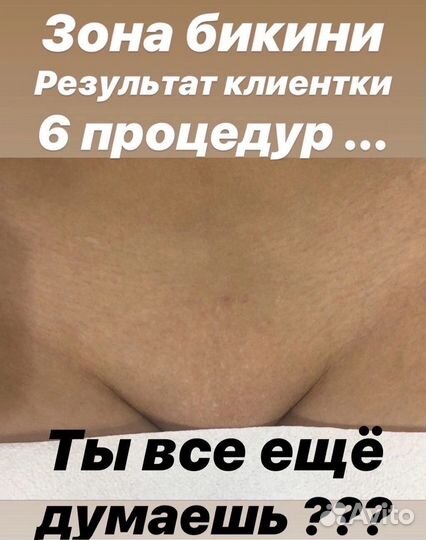 Лазерная эпиляция для мужчин,женщин,Lpg