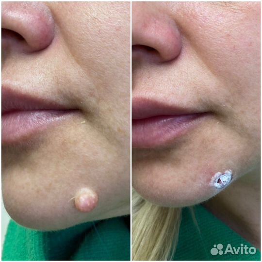 Удаление папилом, фибром, родинок