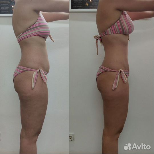 Карамельная липосакция