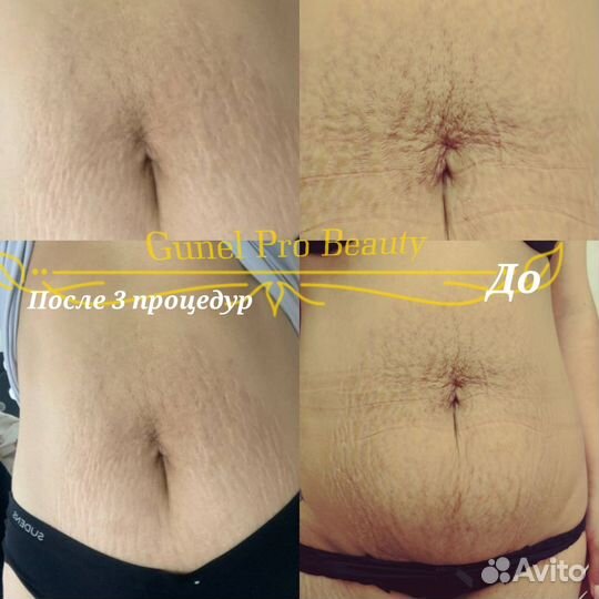 Микроигольчатый Рф-лифтинг