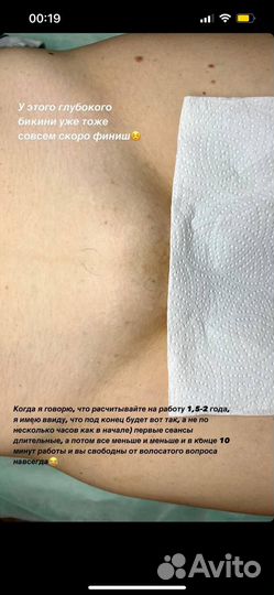 Электроэпиляция классическое бикини