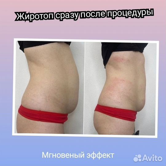 Липолитики мезотерапия