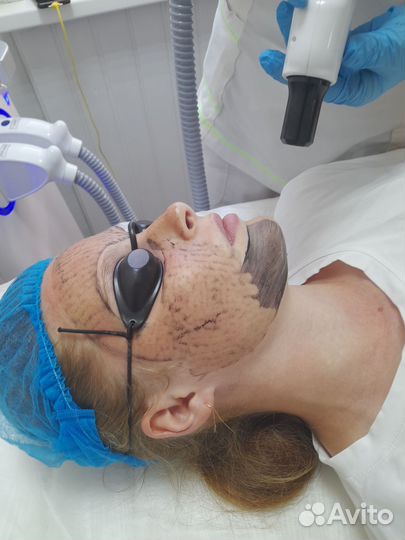 Модели на Карбоновый пилинг