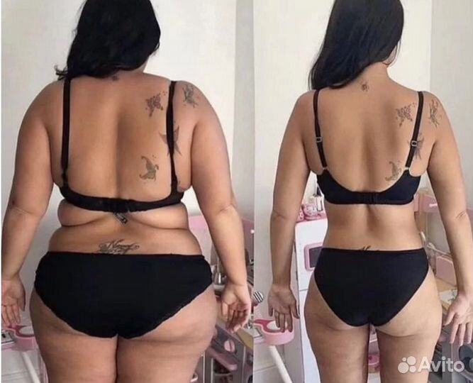 Жиротоп Кавитация, RF лифтинг