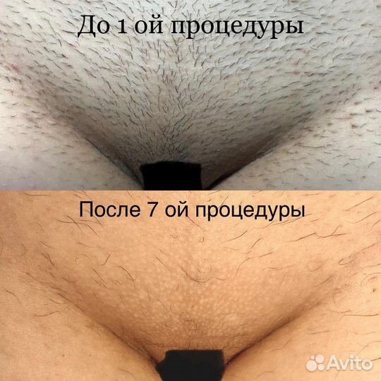 Электроэпиляция: голени