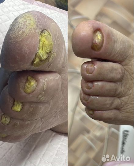 Подолог с выездом на дом