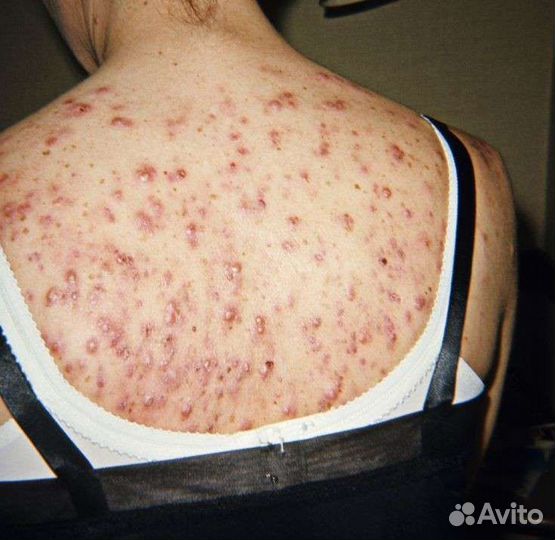 Лечение акне аппаратом навсегда