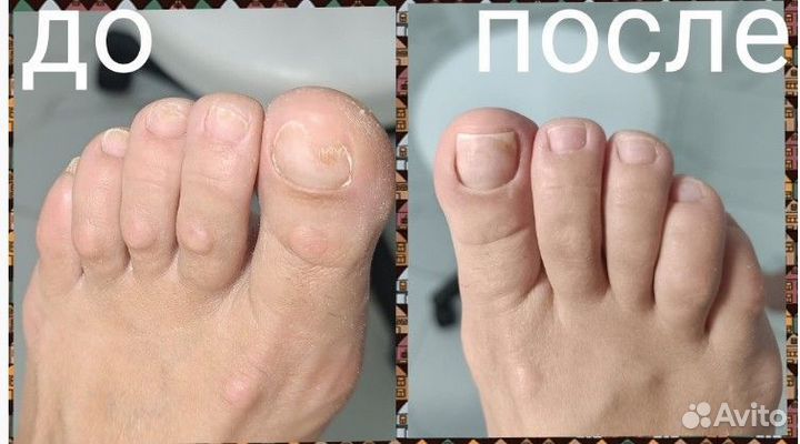 Медицинский педикюр, подолог Адлер