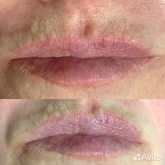Hydrafacial,фракционая меза лица,тела,головы,рук