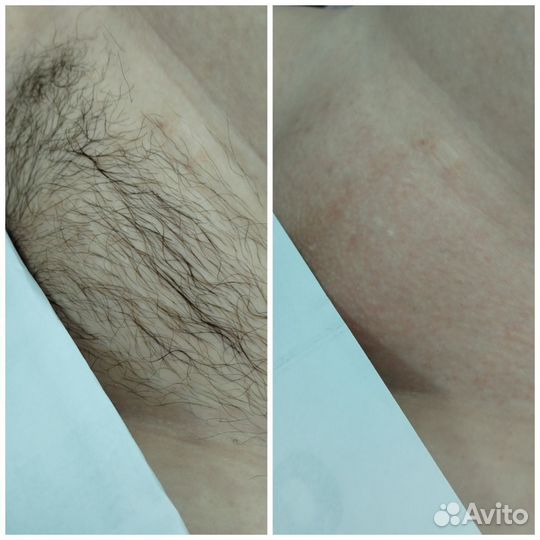 Депиляция/Воск/Шугаринг