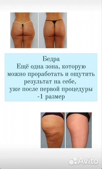 Криолиполиз