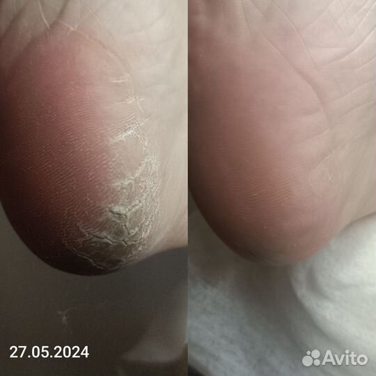 Педикюр kane PAP, парамедицинский, подология