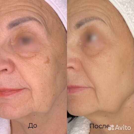 BBL Forever Young RF lifting