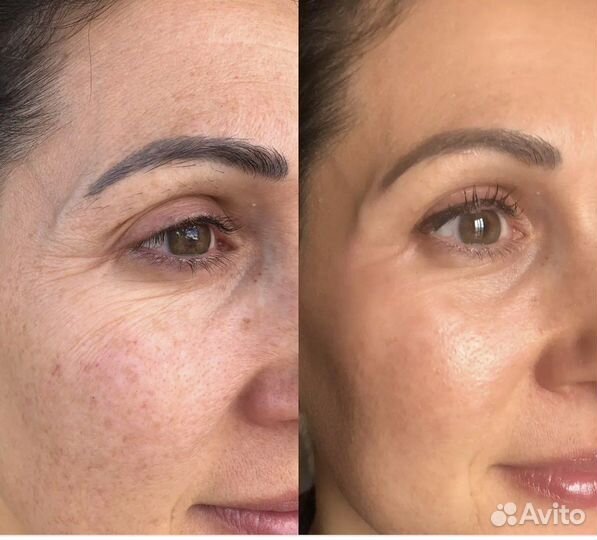 Подтяжка кожи верхнего и нижнего века