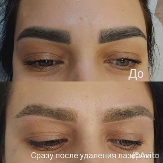 Лазерное удаление тату и перманентного макияжа