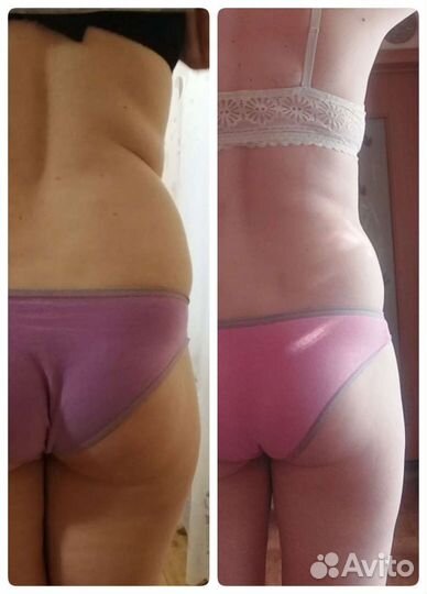 Антицеллюлитный массаж, коррекция фигуры