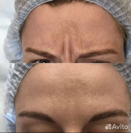 Ботокс лица, Гипергидроз подмышек