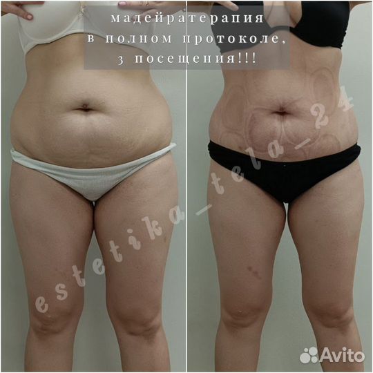 Антицеллюлитный массаж / коррекция фигуры / LPG